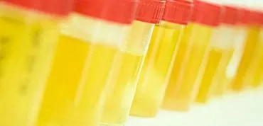 Spilgti dzeltens urīns: galvenie parādības cēloņi. Ko nozīmē izmaiņas urīna krāsā?