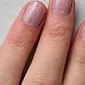 Pirkstu nagi kļūst zili: cēloņi un ārstēšana