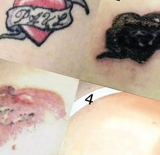 Sliten tatovering på kroppen - fjern den hjemme