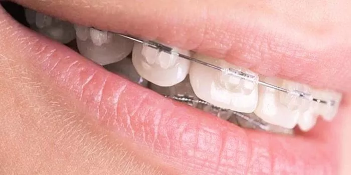 Zobi ir vienmērīgi un ne pārāk labi: kāpēc šķībi zobi sapņo?