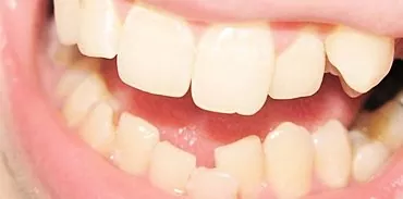 歯は均一であまり良くありません：曲がった歯はなぜ夢を見るのですか？