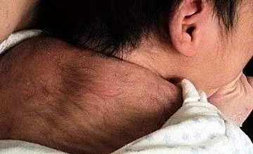 این بیماری عجیب - موی سر در نوزادان چیست؟
