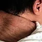 این بیماری عجیب - موی سر در نوزادان چیست؟