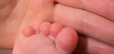 מדוע לילד יש עור בין בהונות הידיים? גורם ודרכי התמודדות עם המחלה
