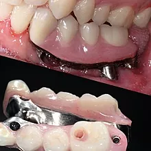 Brug op tanden: de hele waarheid over de procedure