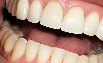 סידן לשיניים: כיצד לחדש את מאגרי היסוד בגוף?