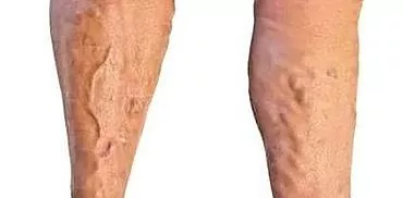 פקקת ורידים בגפיים התחתונות: סיבות, תסמינים, טיפול