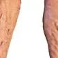 פקקת ורידים בגפיים התחתונות: סיבות, תסמינים, טיפול
