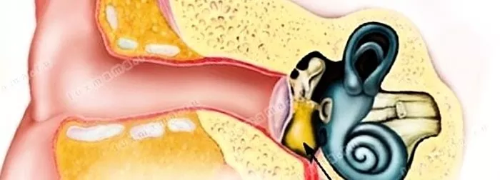 Zapalenie przewodu słuchowego: przyczyny, objawy, leczenie