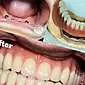 Keraamiset hammasproteesit: hoidon edut, haitat ja vivahteet