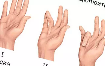 التهاب تاندون دست