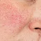 Hva er særegenheten ved rosacea i ansiktet?