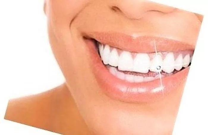 Berlian imitasi di gigi