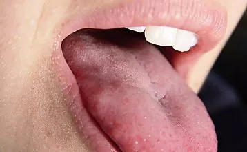 Pertumbuhan lidah: papilloma tidak berbahaya atau pertumbuhan barah?