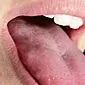 גידולים בלשון: פפילומות לא מזיקות או גידול סרטני?