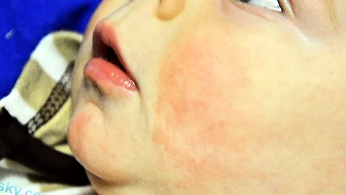 子供のアトピー性皮膚炎：原因、症状、治療