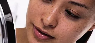 Maneres de tractar l'acne fred a la cara
