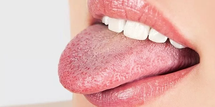 Apakah lepuh di mulut dan lidah merupakan cacat atau gejala dari suatu penyakit?