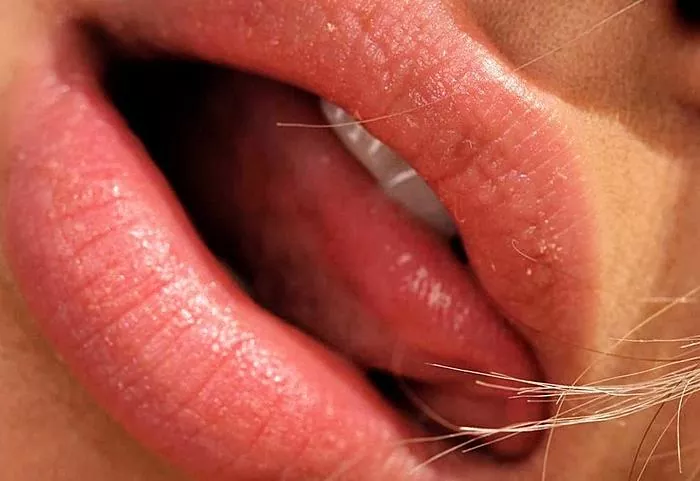 Apakah lepuh di mulut dan lidah merupakan cacat atau gejala dari suatu penyakit?