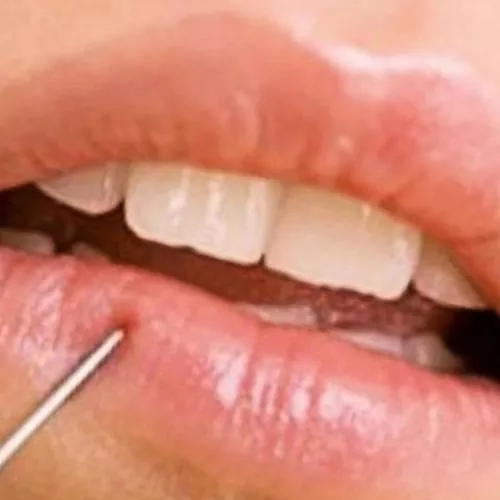 Penyebab bibir mati rasa: apakah ada proses patologis?