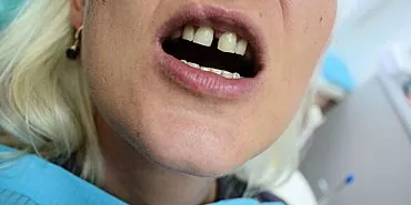Como remover a lacuna entre os dentes anteriores?