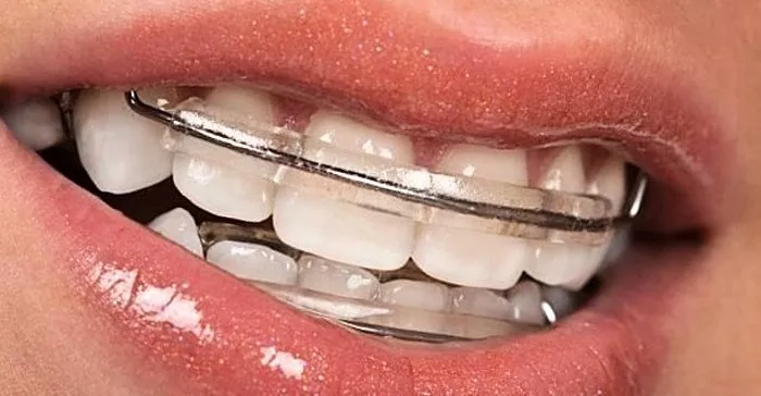 Kawat gigi