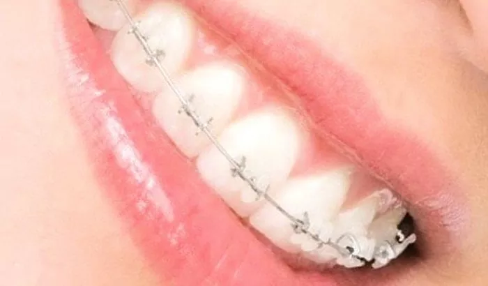 Kawat gigi