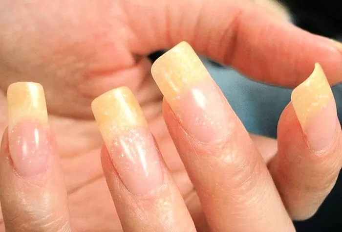 Miks muutuvad sõrmeküüned kollaseks?