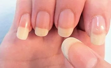 Per què les ungles es tornen grogues?
