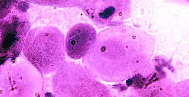 Κυτταρολυτική κολπίτιδα: αιτίες, συμπτώματα, θεραπεία