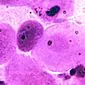 Viêm âm đạo do phân bào: nguyên nhân, triệu chứng, cách điều trị