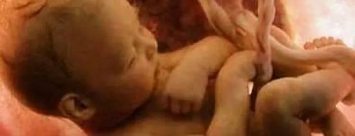 Poprečni prikaz (položaj) fetusa: uzroci i posljedice