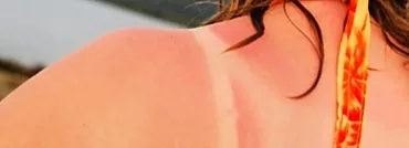 太陽の下での皮膚：灼熱の光線からそれを保護する方法は？