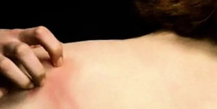 Pruritus: rasa gatal yang menyiksa terkait dengan berbagai penyebab