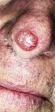 Basalioma hidung: bagaimana penyakit itu menampakkan diri dan bagaimana merawatnya?
