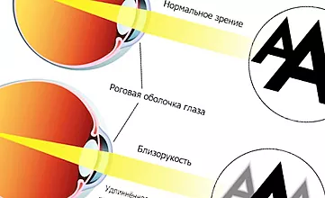 A myopia okai és kezelése