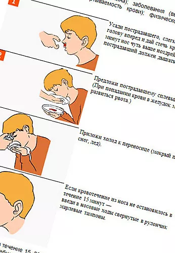 Koji su uzroci krvarenja iz nosa u djece?