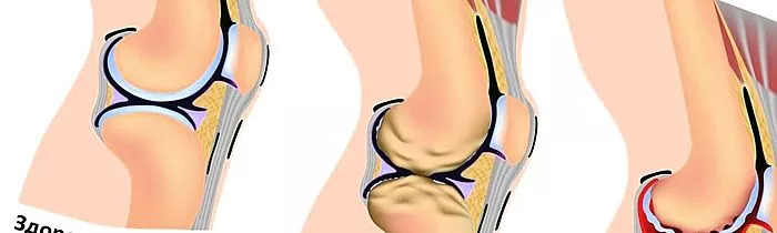 Zašto dolazi do klika pri savijanju koljena?