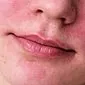 鼻の赤い斑点：どのように戦うか、そしてどのように排除するか？