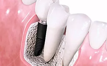 Salauztais zobs nav problēma: mēs pētām modernas protezēšanas metodes