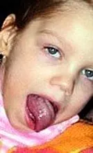 バルバー症候群：子供と大人の病状の原因、症状、治療の特徴