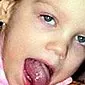 バルバー症候群：子供と大人の病状の原因、症状、治療の特徴