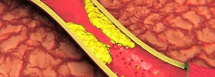 Serebral damarların daralması: semptomlar, nedenler, tanı, tedavi