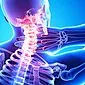 استئوکندروز ستون فقرات گردنی: علائم ، نحوه درمان