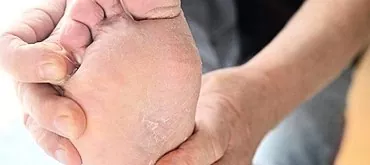 Apa yang perlu dilakukan sekiranya kulit di kaki antara jari kaki mengelupas dan mengelupas?