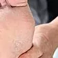 اگر پوست پاهای بین انگشتان پا کنده و کنده شود ، چه باید کرد؟