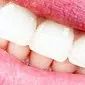 Hampaiden mustan plakin syyt ja niiden poistaminen