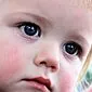 قرمزی سفیدی چشم در کودک. دلایل بروز این علامت و روش های مقابله با آن