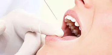 歯の神経はどのように除去されますか？