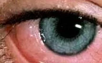 Príznaky a liečba červov v očiach